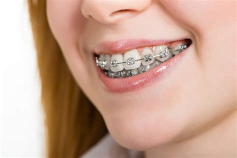 todo sobre brackets metalicos|precio de bracket dental.